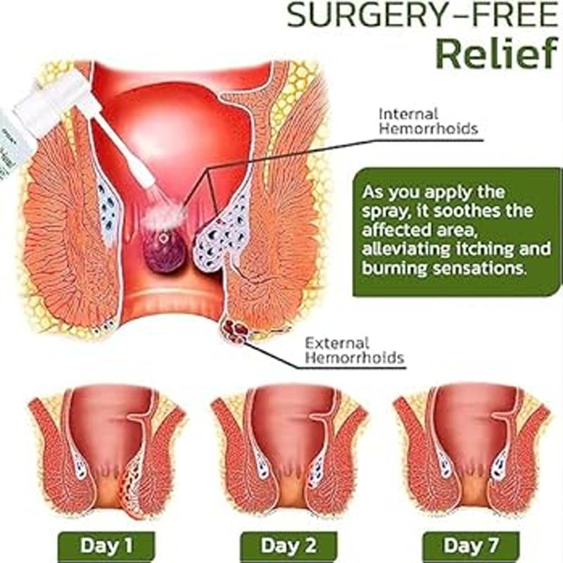 Herbal Hemorrhoids Spray